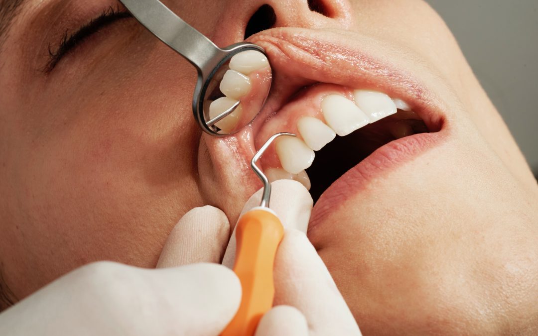 ¿Conoces los diferentes tipos de blanqueamiento dental?