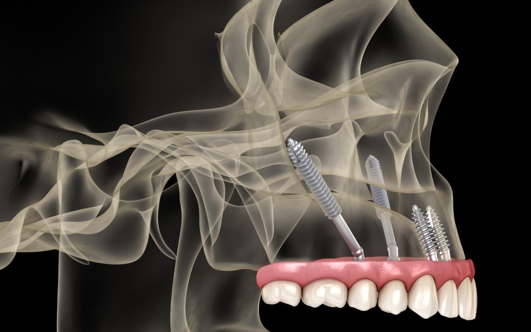 Una alternativa segura y efectiva Implantes cigomáticos en odontología